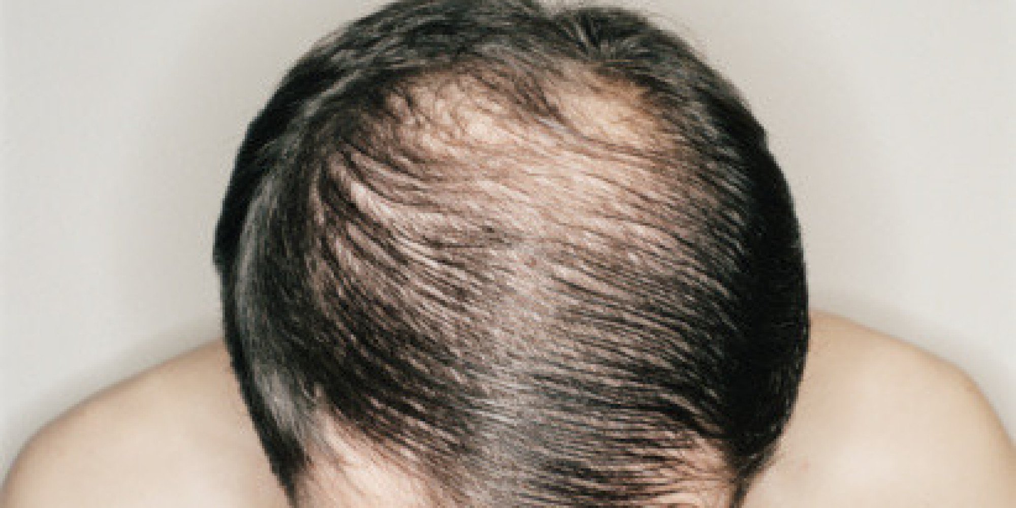 baldness treatment